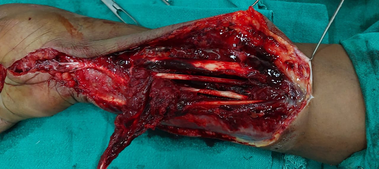 Crush injury surgery showing exposed forearm tendons during repair