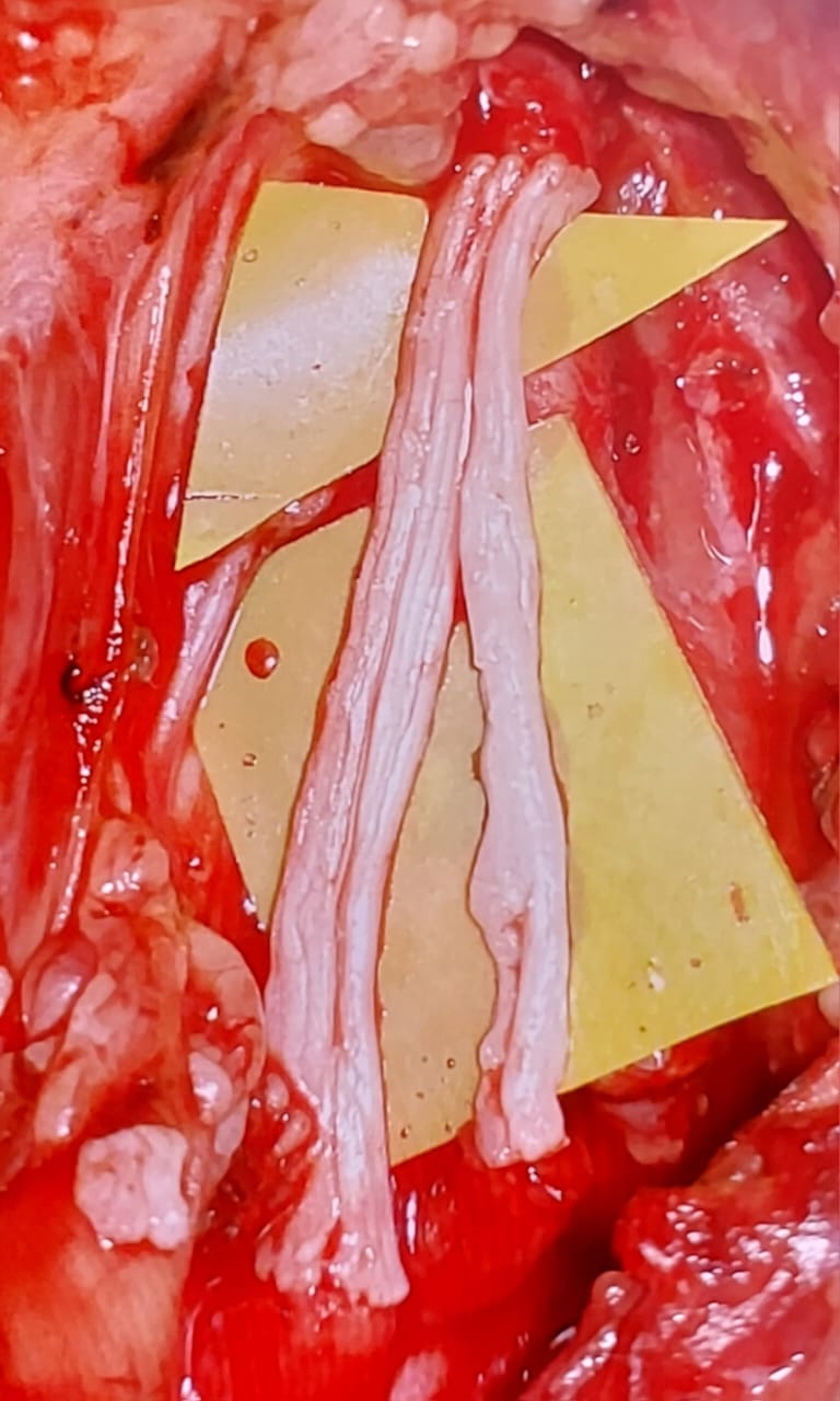 Microsurgical nerve repair with nerve grafts under operative microscope