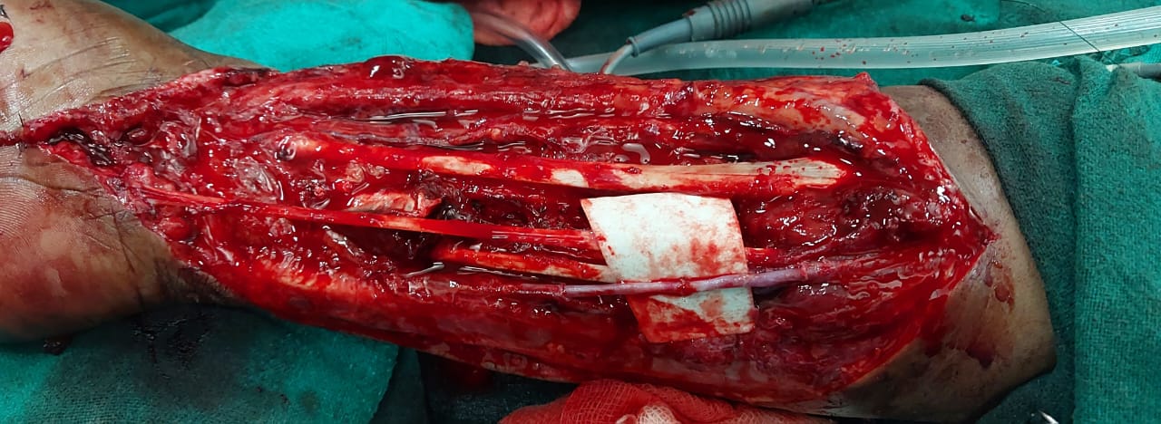 Microsurgical vessel repair in forearm with vascular grafts