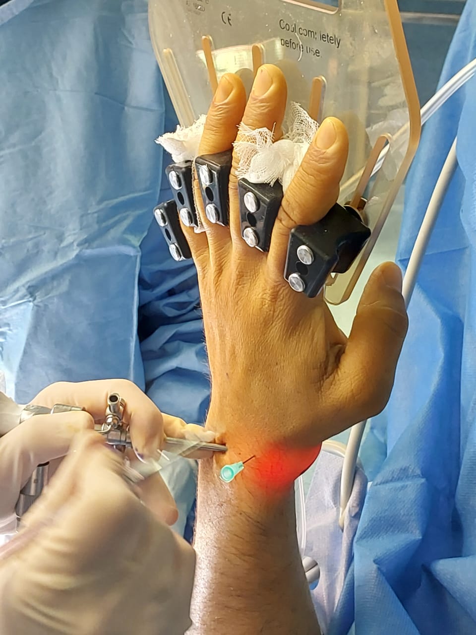Wrist arthroscopy procedure with finger traps and arthroscope insertion