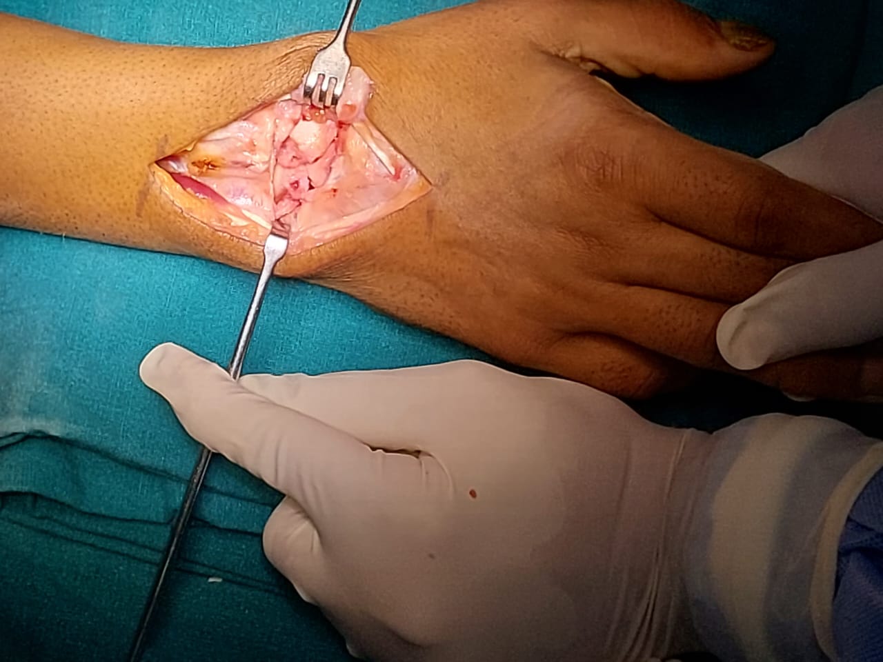 Open wrist surgery for carpal tunnel release and wrist fracture fixation